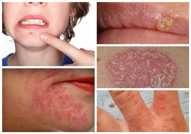 Алергія та шкірні захворювання – ознаки паразитів в організмі
