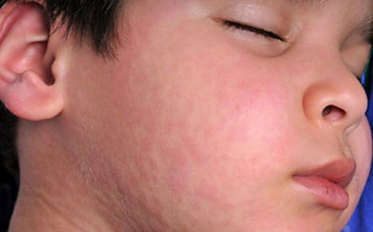 Алергічні висипання на шкірі – симптом наявності в організмі паразитичних хробаків